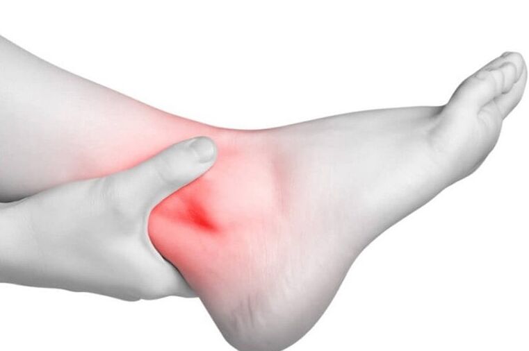 Arthritis with gout